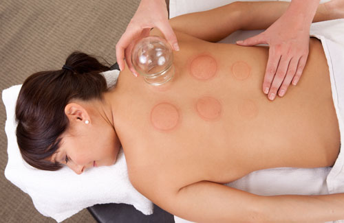 Cupping - Trenton Massage and Lymphedema Clinic